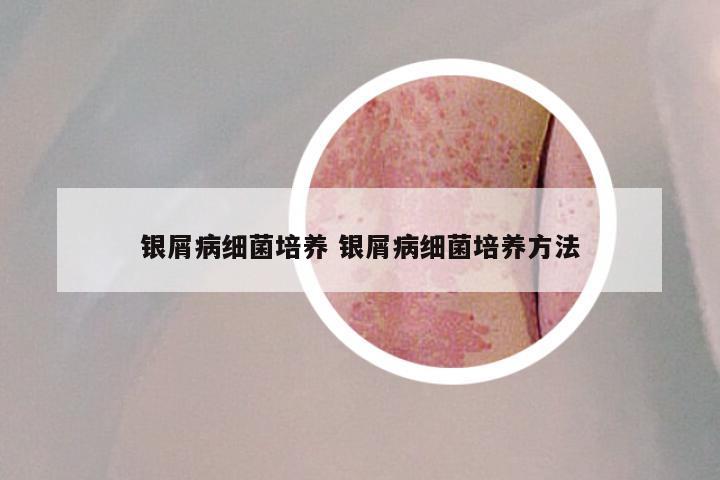 银屑病细菌培养 银屑病细菌培养方法