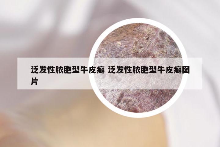 泛发性脓胞型牛皮癣 泛发性脓胞型牛皮癣图片