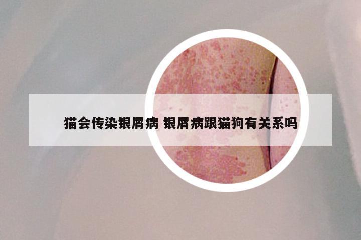 猫会传染银屑病 银屑病跟猫狗有关系吗