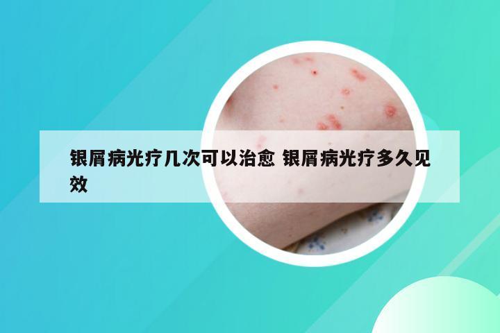 银屑病光疗几次可以治愈 银屑病光疗多久见效