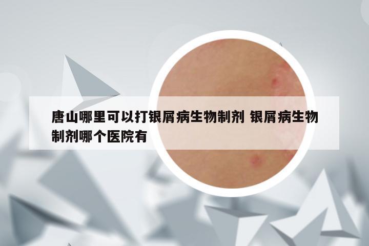 唐山哪里可以打银屑病生物制剂 银屑病生物制剂哪个医院有