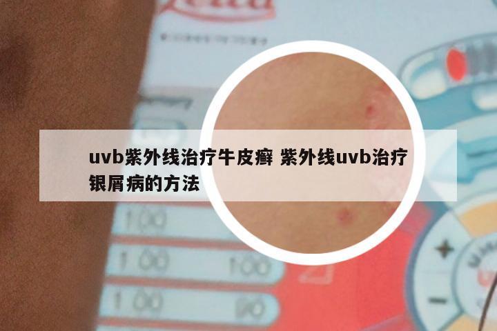 uvb紫外线治疗牛皮癣 紫外线uvb治疗银屑病的方法