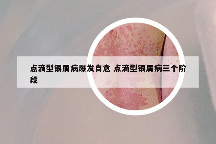 点滴型银屑病爆发自愈 点滴型银屑病三个阶段