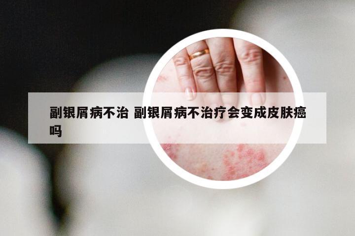 副银屑病不治 副银屑病不治疗会变成皮肤癌吗