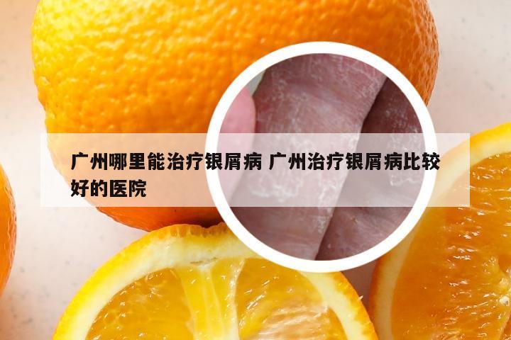 广州哪里能治疗银屑病 广州治疗银屑病比较好的医院