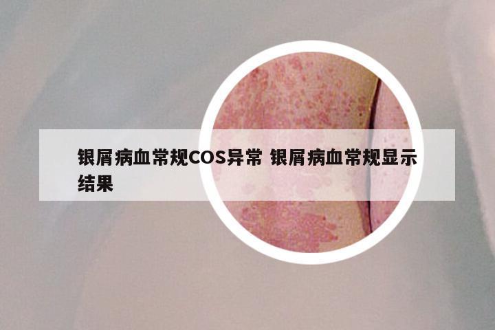 银屑病血常规COS异常 银屑病血常规显示结果