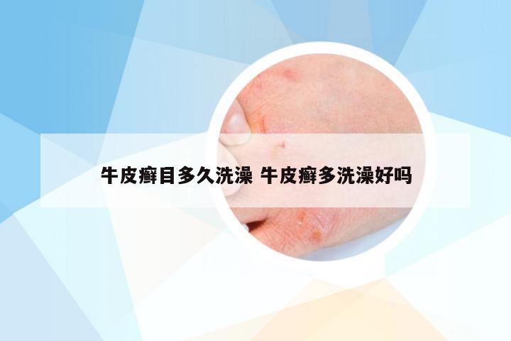 牛皮癣目多久洗澡 牛皮癣多洗澡好吗