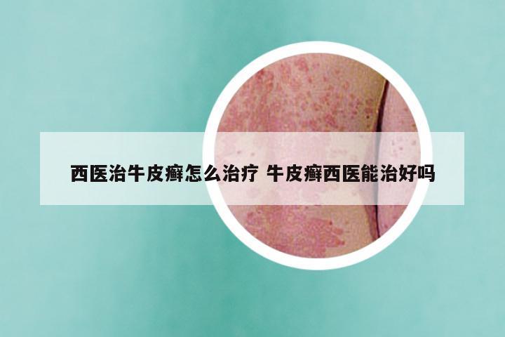 西医治牛皮癣怎么治疗 牛皮癣西医能治好吗