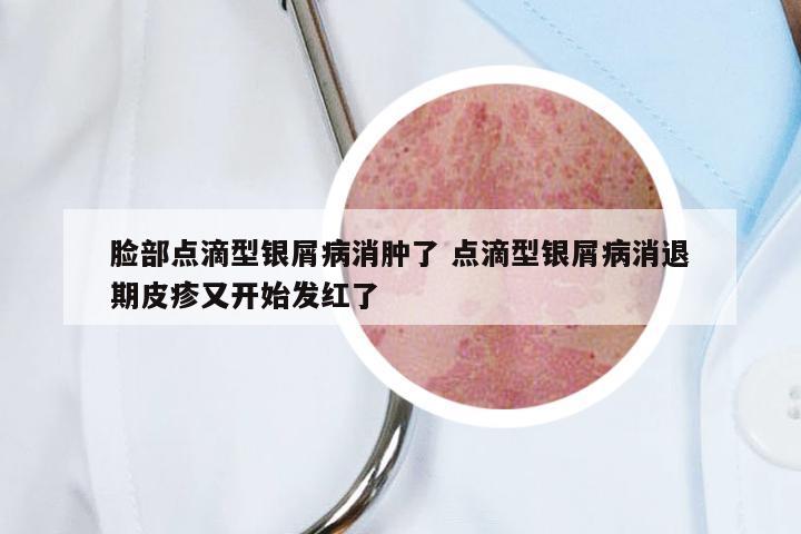脸部点滴型银屑病消肿了 点滴型银屑病消退期皮疹又开始发红了