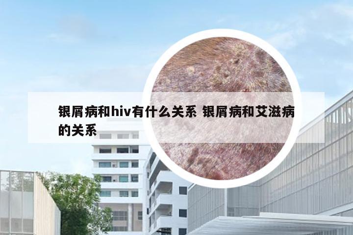 银屑病和hiv有什么关系 银屑病和艾滋病的关系