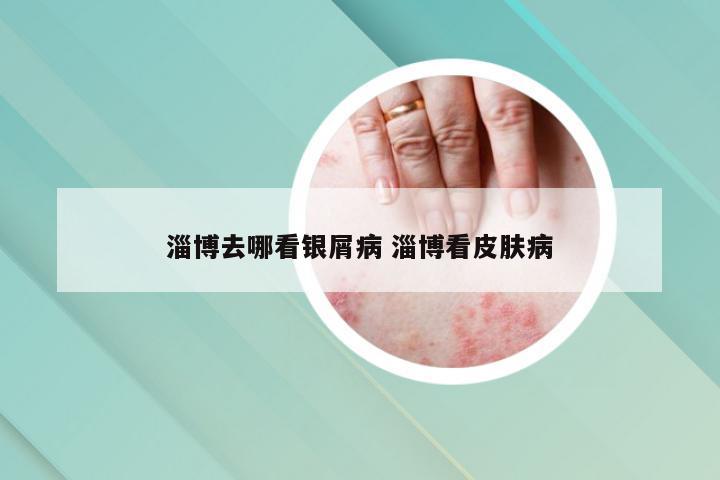 淄博去哪看银屑病 淄博看皮肤病