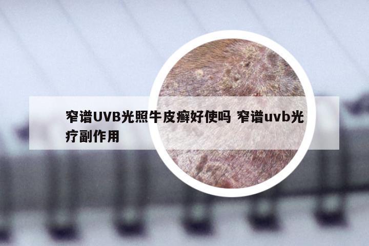 窄谱UVB光照牛皮癣好使吗 窄谱uvb光疗副作用