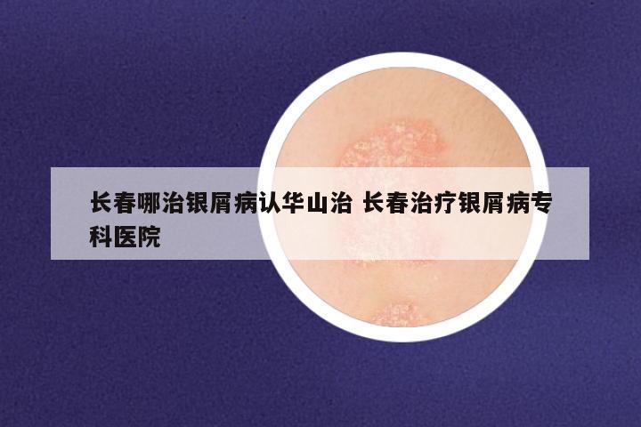 长春哪治银屑病认华山治 长春治疗银屑病专科医院