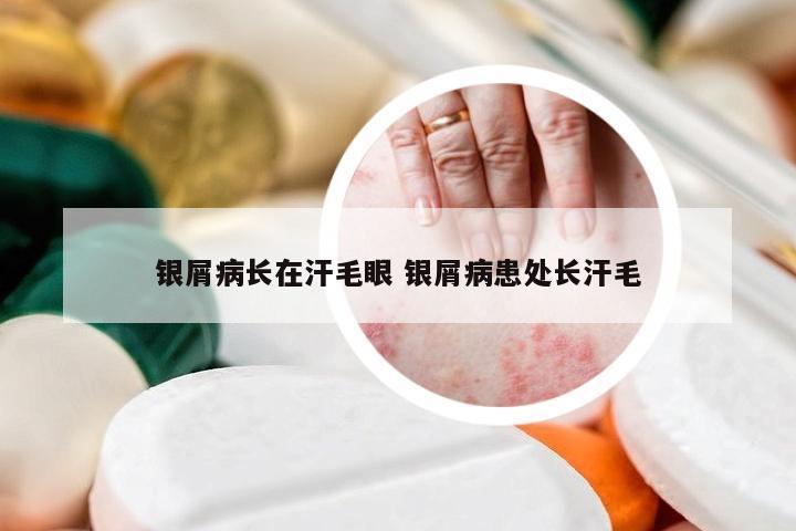银屑病长在汗毛眼 银屑病患处长汗毛