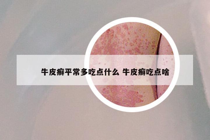 牛皮癣平常多吃点什么 牛皮癣吃点啥