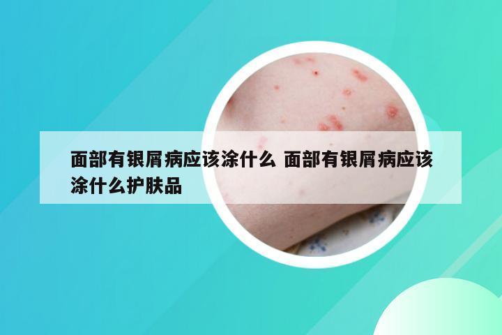 面部有银屑病应该涂什么 面部有银屑病应该涂什么护肤品