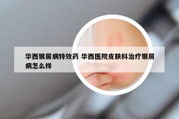 华西银屑病特效药 华西医院皮肤科治疗银屑病怎么样
