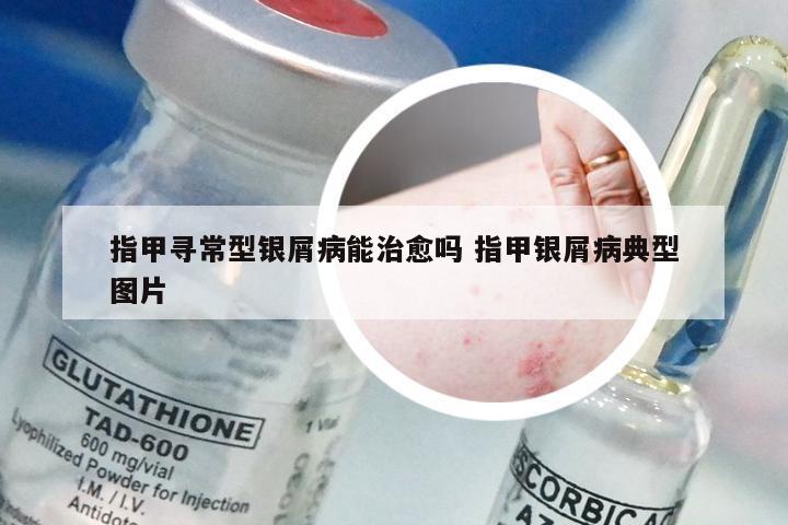 指甲寻常型银屑病能治愈吗 指甲银屑病典型图片