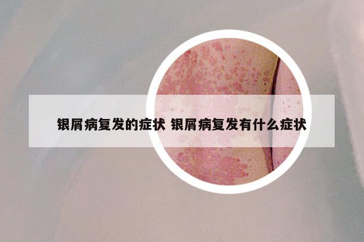 银屑病复发的症状 银屑病复发有什么症状