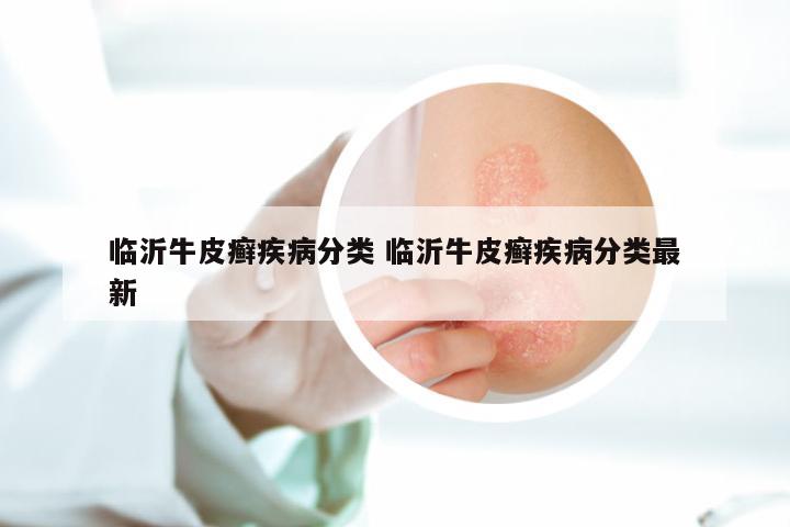 临沂牛皮癣疾病分类 临沂牛皮癣疾病分类最新