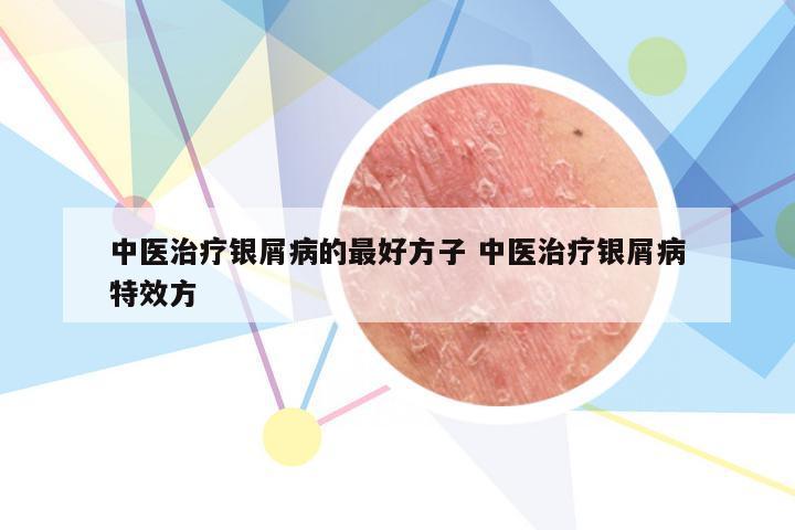 中医治疗银屑病的最好方子 中医治疗银屑病特效方