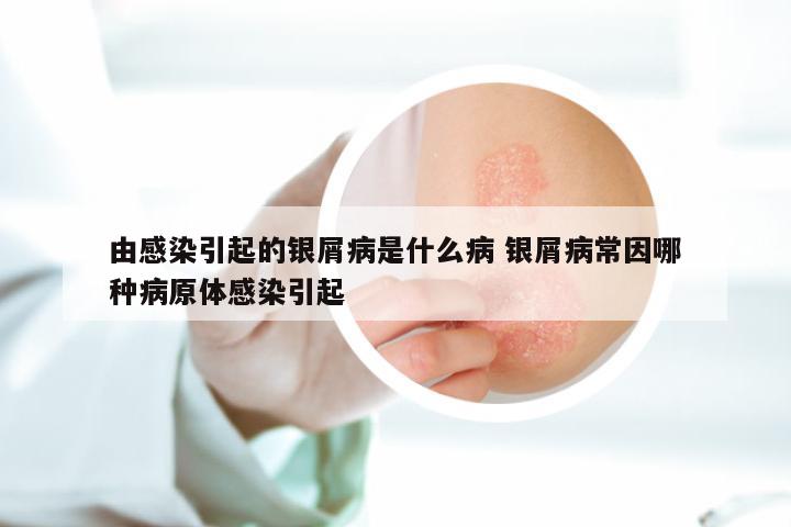 由感染引起的银屑病是什么病 银屑病常因哪种病原体感染引起