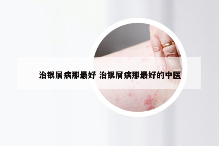 治银屑病那最好 治银屑病那最好的中医