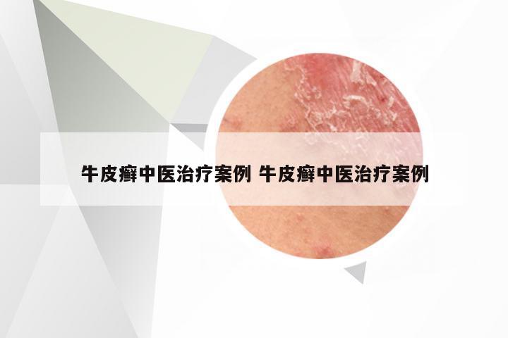 牛皮癣中医治疗案例 牛皮癣中医治疗案例