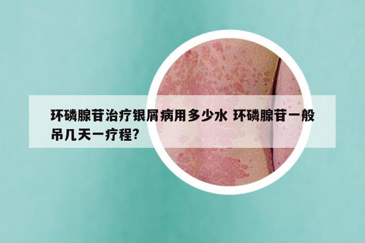 环磷腺苷治疗银屑病用多少水 环磷腺苷一般吊几天一疗程?