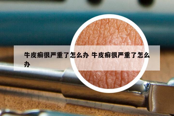 牛皮癣很严重了怎么办 牛皮癣很严重了怎么办