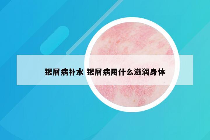 银屑病补水 银屑病用什么滋润身体