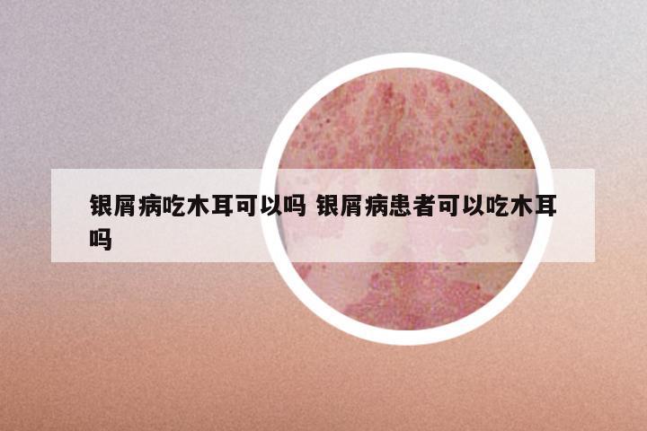 银屑病吃木耳可以吗 银屑病患者可以吃木耳吗