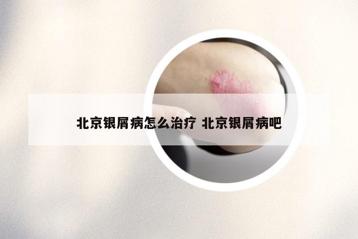 北京银屑病怎么治疗 北京银屑病吧