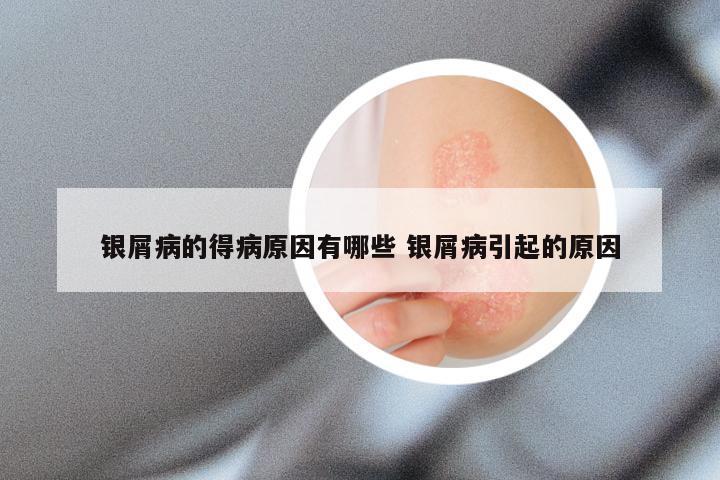 银屑病的得病原因有哪些 银屑病引起的原因