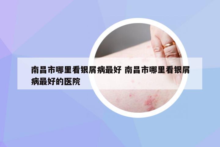 南昌市哪里看银屑病最好 南昌市哪里看银屑病最好的医院