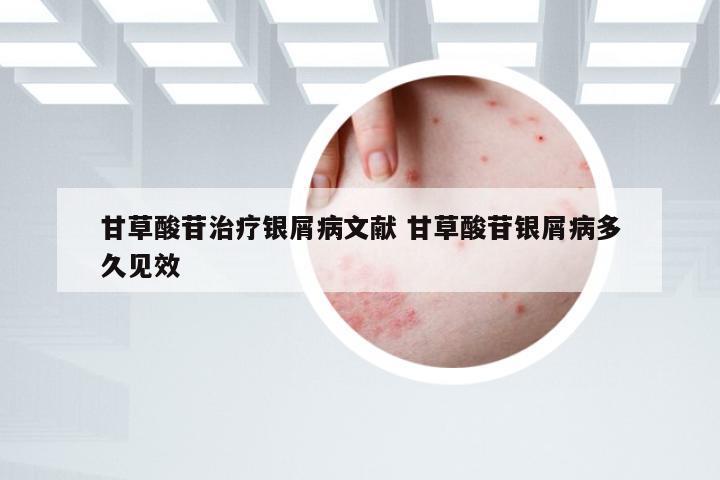 甘草酸苷治疗银屑病文献 甘草酸苷银屑病多久见效