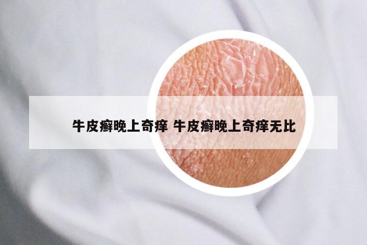 牛皮癣晚上奇痒 牛皮癣晚上奇痒无比