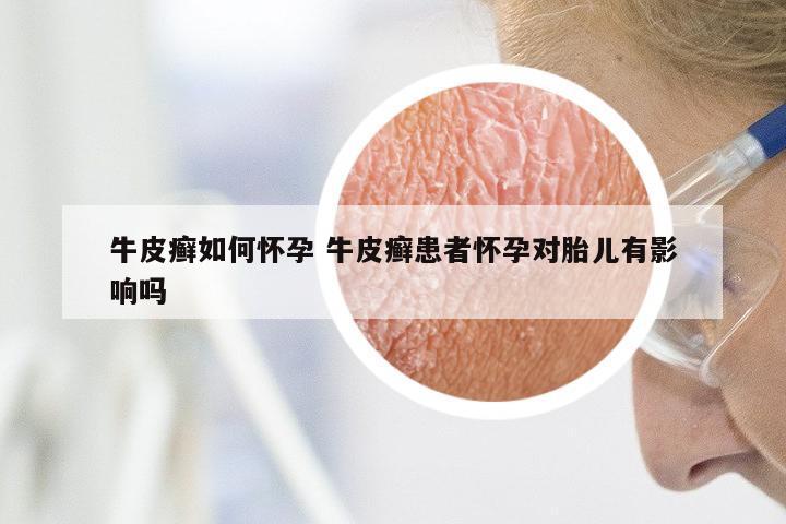 牛皮癣如何怀孕 牛皮癣患者怀孕对胎儿有影响吗