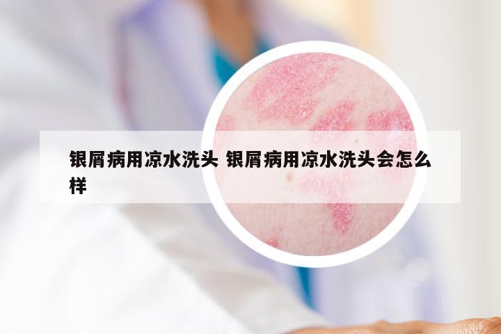 银屑病用凉水洗头 银屑病用凉水洗头会怎么样