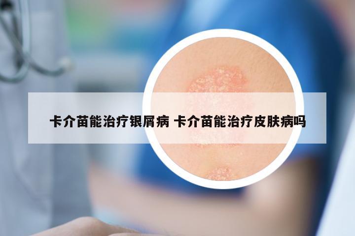卡介苗能治疗银屑病 卡介苗能治疗皮肤病吗