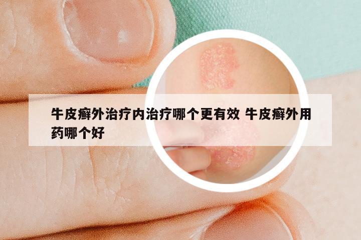 牛皮癣外治疗内治疗哪个更有效 牛皮癣外用药哪个好