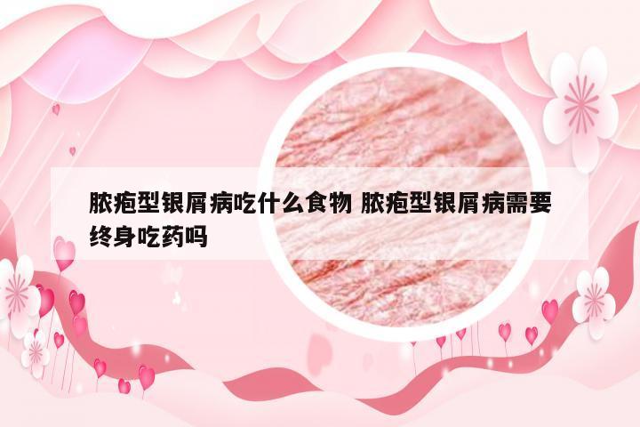 脓疱型银屑病吃什么食物 脓疱型银屑病需要终身吃药吗