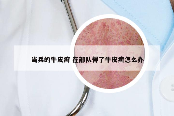 当兵的牛皮癣 在部队得了牛皮癣怎么办