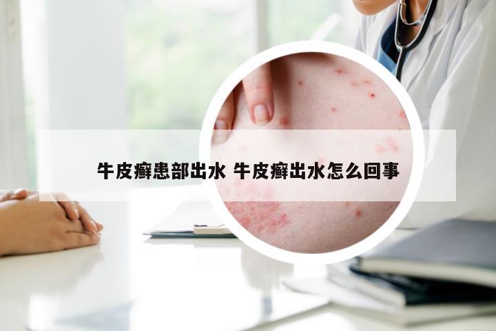 牛皮癣患部出水 牛皮癣出水怎么回事