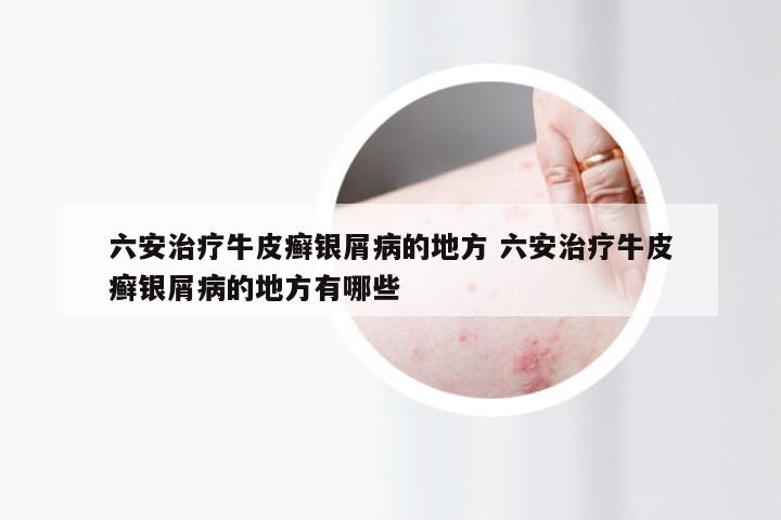 六安治疗牛皮癣银屑病的地方 六安治疗牛皮癣银屑病的地方有哪些