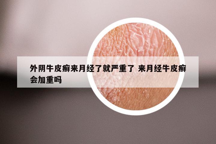 外阴牛皮癣来月经了就严重了 来月经牛皮癣会加重吗