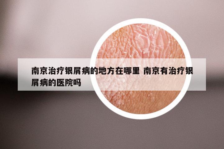 南京治疗银屑病的地方在哪里 南京有治疗银屑病的医院吗