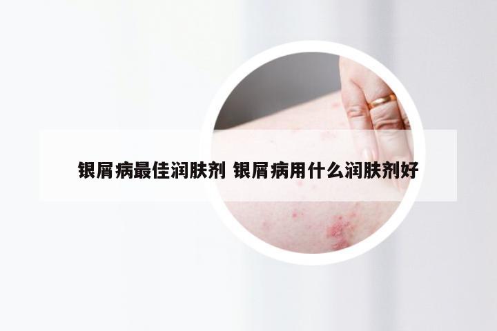 银屑病最佳润肤剂 银屑病用什么润肤剂好