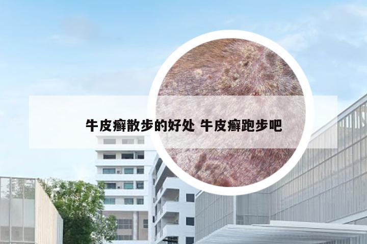牛皮癣散步的好处 牛皮癣跑步吧