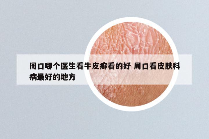 周口哪个医生看牛皮癣看的好 周口看皮肤科病最好的地方